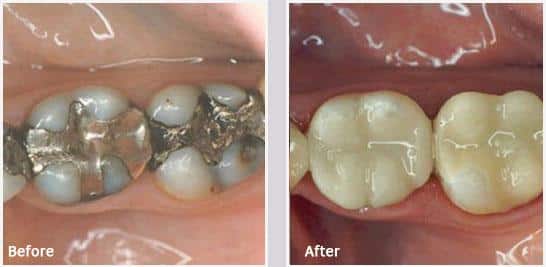 Amalgam Removal