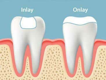 Inlays and Onlays